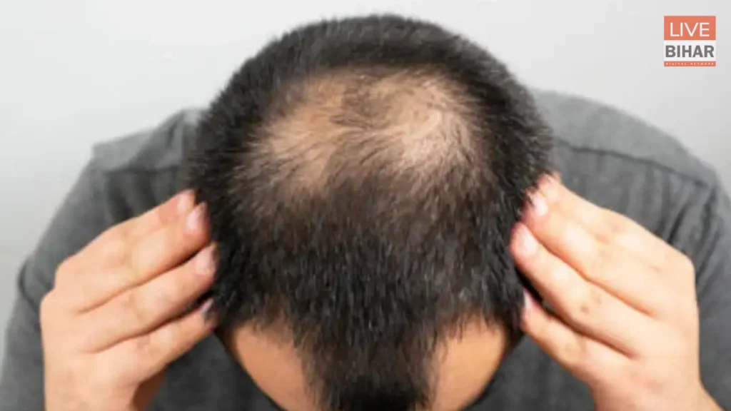 Health Update: पुरुषों में गंजापन क्यों बढ़ रहा है? जानिए गंजेपन के कारण, लक्षण और इलाज की पूरी जानकारी 1
