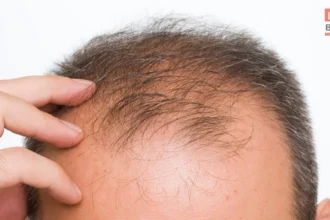 पुरुषों में गंजापन