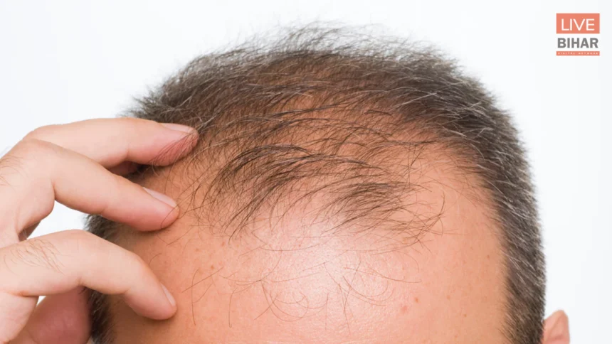 पुरुषों में गंजापन
