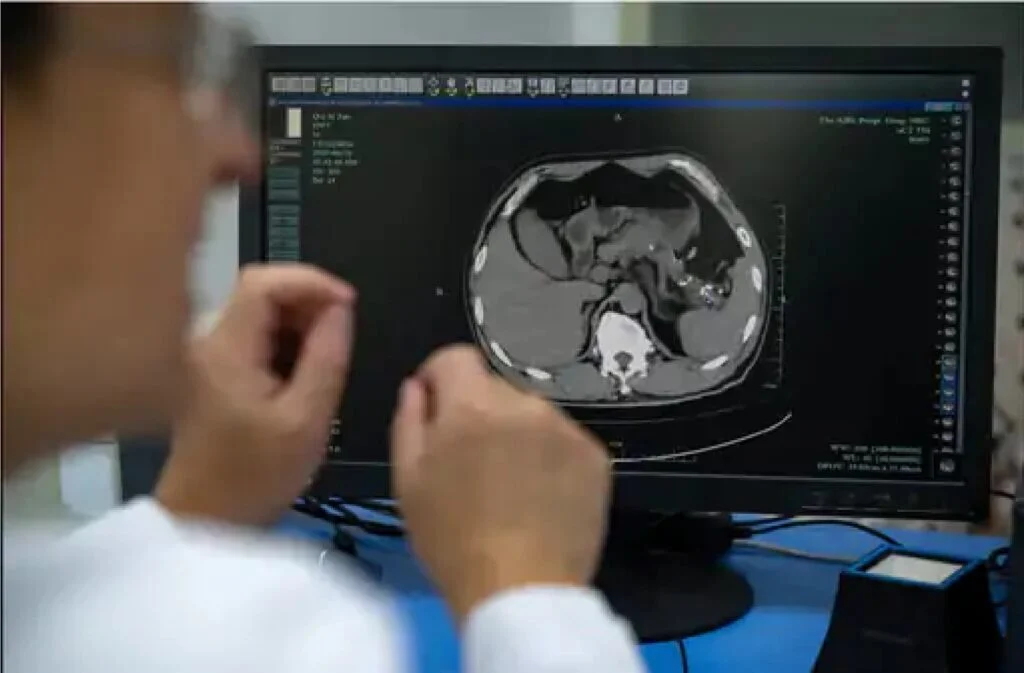 Pancreatic Cancer AI Detection China: AI ने बिना लक्षण वाला पैंक्रियाज कैंसर पकड़ा, वही बीमारी जिसने एपल CEO स्टीव जॉब्स की जान ली 2